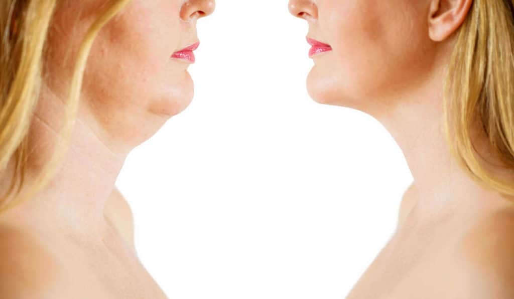 Double Chin treatment Northolt before and after results