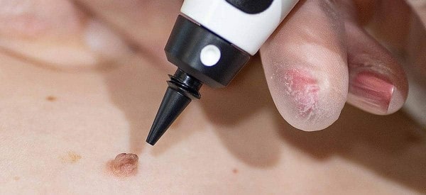 After Skin Tag Removal Northolt