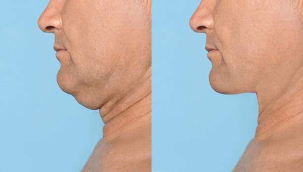 Which Non-Surgical Treatments Work Best for Jowls and Loose Skin Northolt?