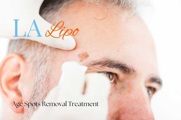 What Are the Most Effective Treatments for Age Spots Northolt?