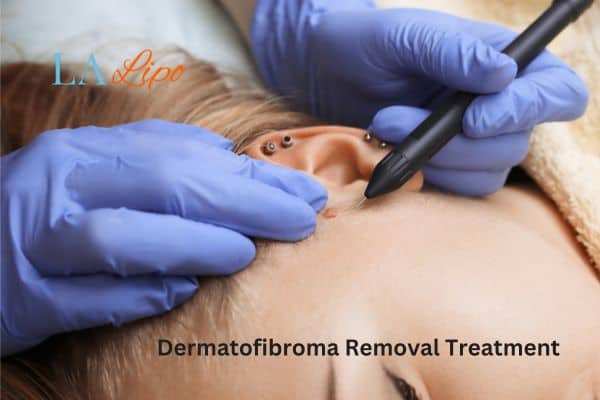 Dermatofibroma Removal Treatment Northolt