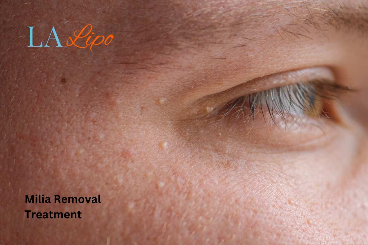 Cryopen Milia Removal: Is It the Easiest and Safest Option Northolt?