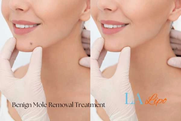 Before-and-after results following benign mole-removal treatment Northolt
