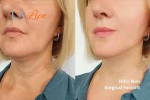 hi-fu for wrinkles Northolt before and after results