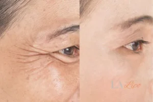 Before and after results of woman - HI-fu wrinkles reduction treatment Northolt
