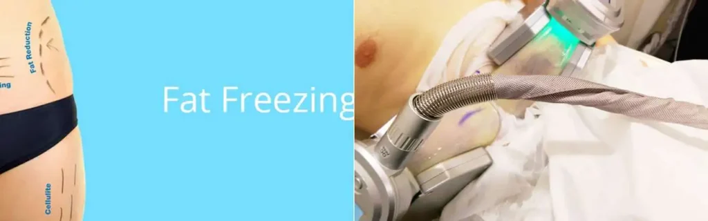 Fat freezing Northolt on multiple areas of the body