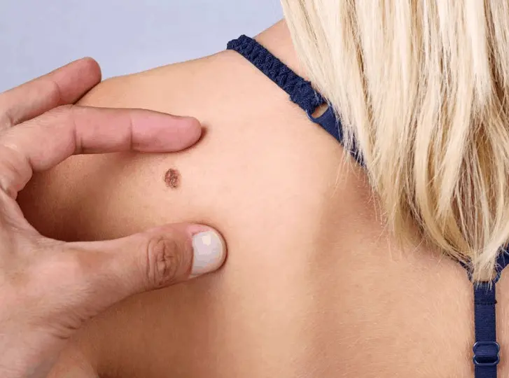 woman having mole removal Northolt consultation before treatment.