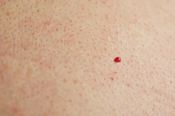 close up of a cherry angioma Northolt