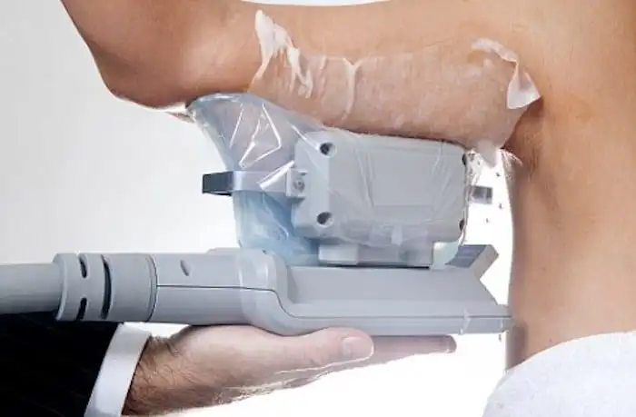 Picture of fat freezing Northolt on the upper arms.