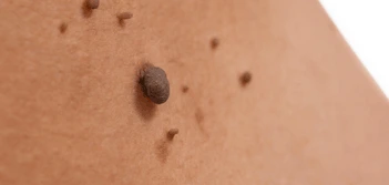 image of a skin tag Northolt