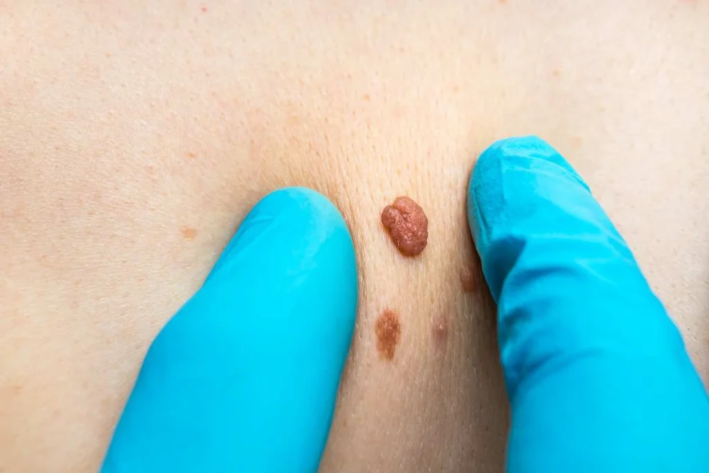 Consultant examining a skin tag Northolt