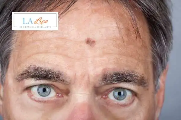 Solar Lentigo Removal Northolt image of man with mark on his forehead