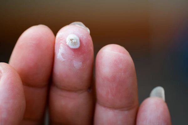 wart on person finger - cryotherapy to treat from LA LIPO Northolt