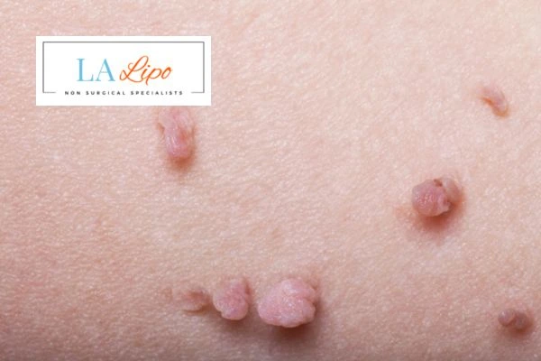 Does cryopen skin tag removal Northolt hurt? Find out now call our team today!