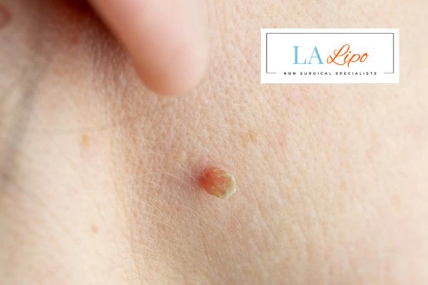 Book skin tag removal Northolt today speak to our team now!