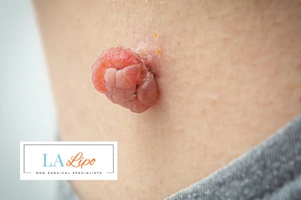Interested in skin tag removal Northolt? Concerned about the pain? Find out more today!