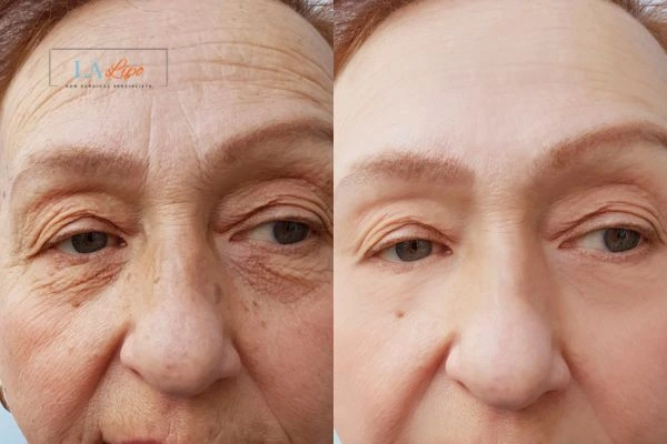 The powerful benefits of Morpheus8 Treatment Northolt - Call Our team today!