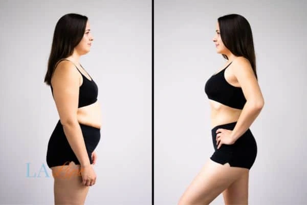 Picture of womans before and after using LA-EMS body sculpting to improve her core strength Northolt