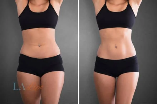 before and after results of non-surgical treatment to help a woman's body image and mental health Northolt