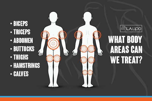 Diagram to show areas you can have LA-EMS Body Sculpting Treatment Northolt