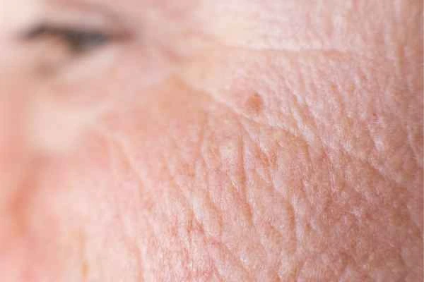 close up picture of a woman's face showing an age spot Northolt