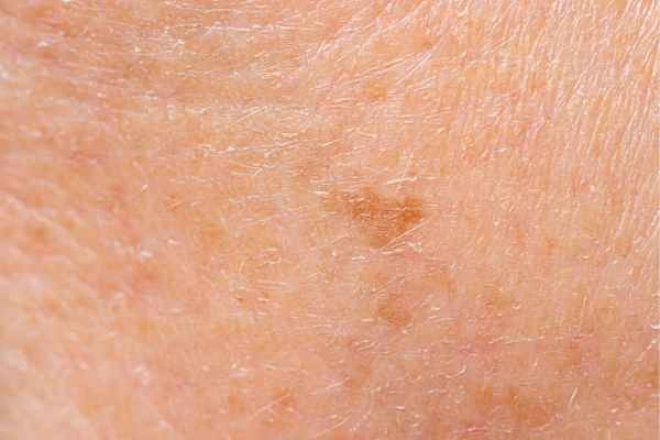 close up picture of age spots Northolt