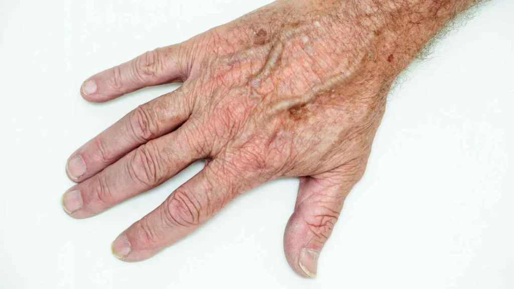 Male hand showing age spot Northolt
