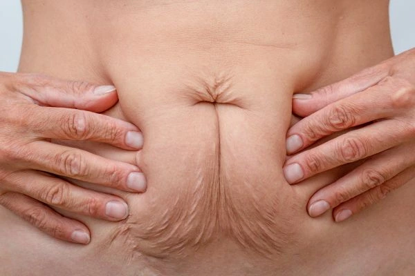 Should I Combine Diastasis Recti Treatment with Body Contouring for Better Results Northolt?