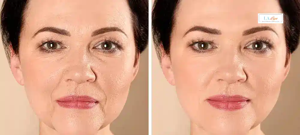 How Long Does It Take to See Results and How Long Do They Last Northolt?