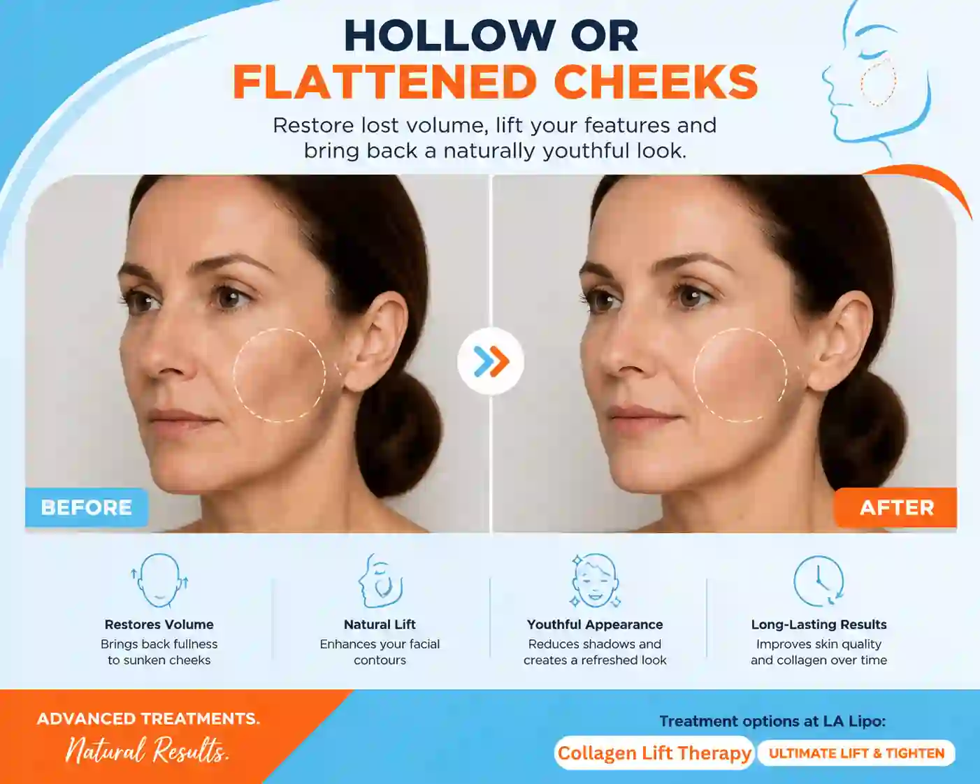 Sign #4: Hollow or Flattened Cheeks Northolt
