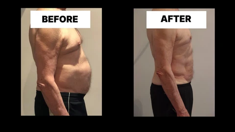 What Symptoms Can Diastasis Recti Cause in Men? Weak Core, Back Pain and Poor Posture Northolt
